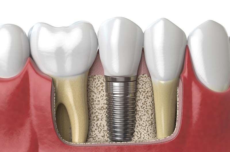 A imagem mostra um desenho 3d de uma arcada dentária inferior. Ao centro estão três dentes e é possível visualizar as suas raízes, o dente do meio é um implante que possui um pino ao invés de raiz.