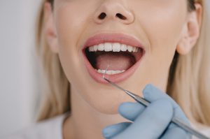 Em uma imagem close-up, uma mulher de pele branca e cabelos loiros está com sua boca aberta enquanto um profissional examina seus dentes inferiores com um instrumento.