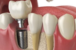 A imagem mostra um desenho 3D de uma arcada dentária. É possível visualizar a parte interna da gengiva onde uma coroa está sendo acoplada ao implante de um dente molar inferior direito.