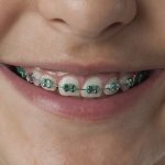 Ao centro da imagem há um close na boca de uma pessoa branca. Ela está sorrindo e sobre os seus dentes há um aparelho ortodôntico, as suas borrachinhas são verdes.