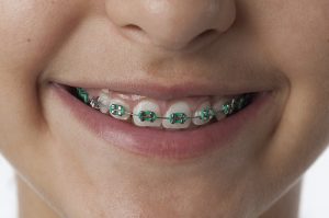 Ao centro da imagem há um close na boca de uma pessoa branca. Ela está sorrindo e sobre os seus dentes há um aparelho ortodôntico, as suas borrachinhas são verdes.