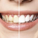 Na imagem é possível ver o sorriso de uma mulher. Ao centro da imagem está uma barra que a divide em duas partes. Ao lado esquerdo estão dentes amarelados, com aspecto de sujos. No lado direito estão dentes brancos e limpos.
