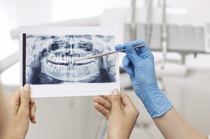 A imagem mostra duas mãos segurando uma radiografia de uma arcada dentária. Do lado direito há uma terceira mão que utiliza luva azul. Ela segura um instrumento odontológico e aponta para o exame de raio-X. Ao fundo da imagem há alguns móveis brancos, todos desfocados.